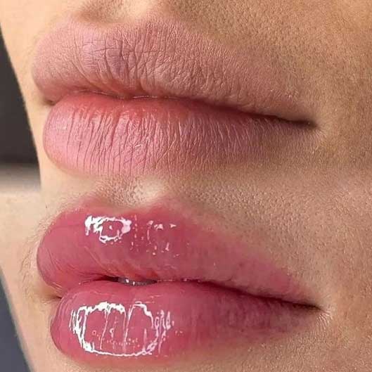 Hidra lips em Pedreiras-MA Trizidela do vale-ma